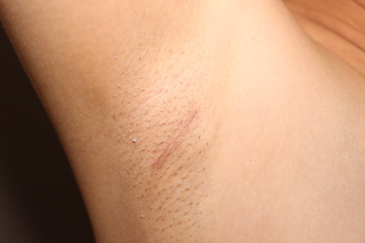 シリコンバック抜去の時の傷　経過１か月