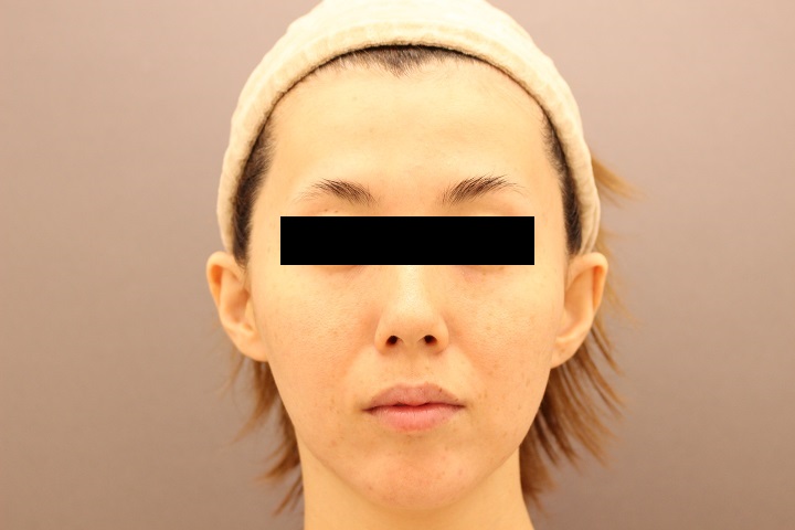 脂肪注入による顔のエイジングケア　１か月後経過