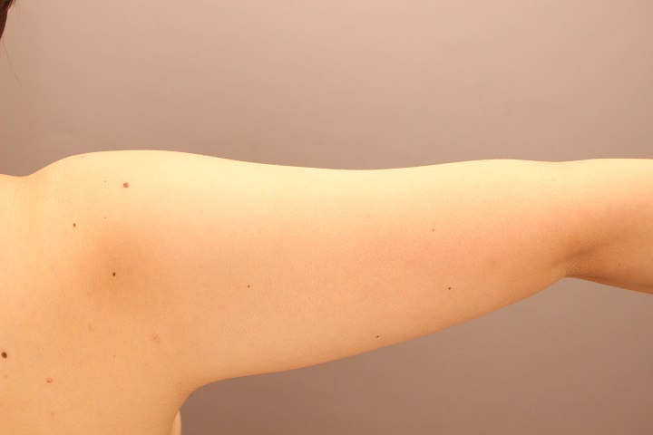 二の腕脂肪吸引　1か月後経過