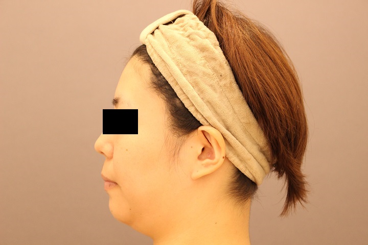 顔の脂肪吸引　２週間後経過