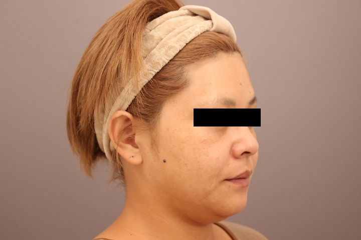 顔の脂肪吸引　１週間後経過
