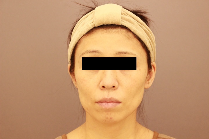 お顔への脂肪注入　手術直後の状態