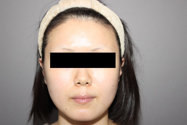 顔の脂肪吸引　３か月経過