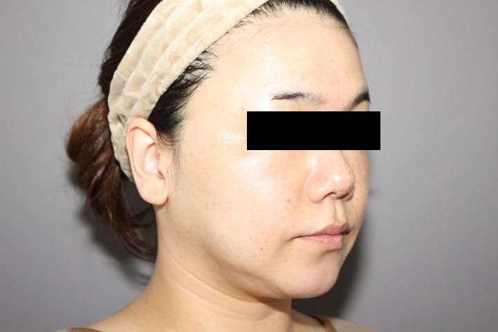 顔の脂肪吸引　３か月経過