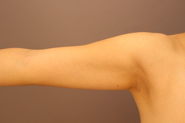 二の腕・肩　脂肪吸引　１か月後経過