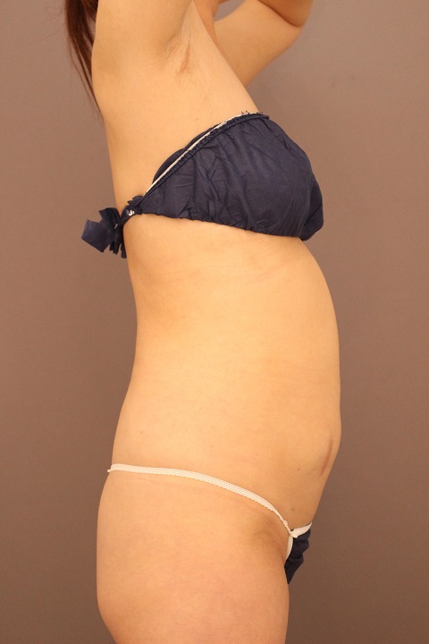 腹部・腰　脂肪吸引　ヒップメイキング　１か月経過