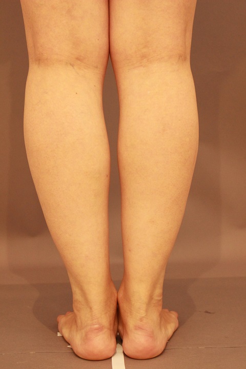 ふくらはぎ・足首の脂肪吸引 1週間後