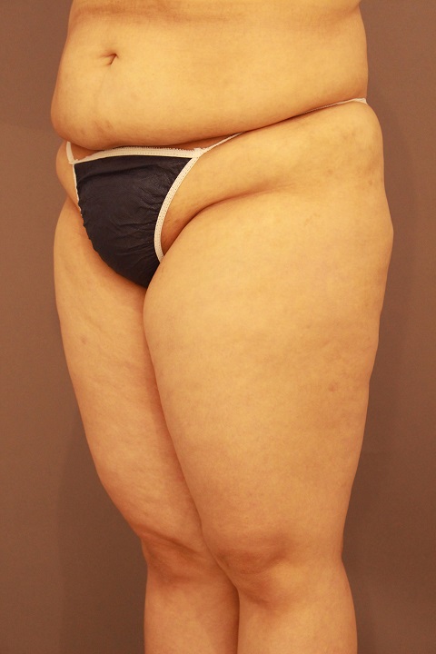 太もも全周　脂肪吸引　１週間後