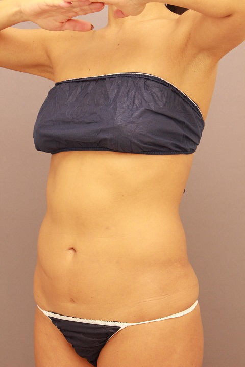 腹部　他院修正　１週間後