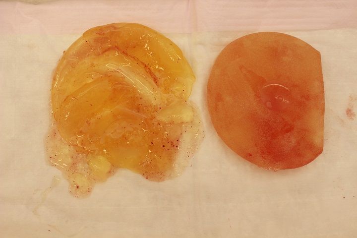 破損したシリコンバックの取り出し