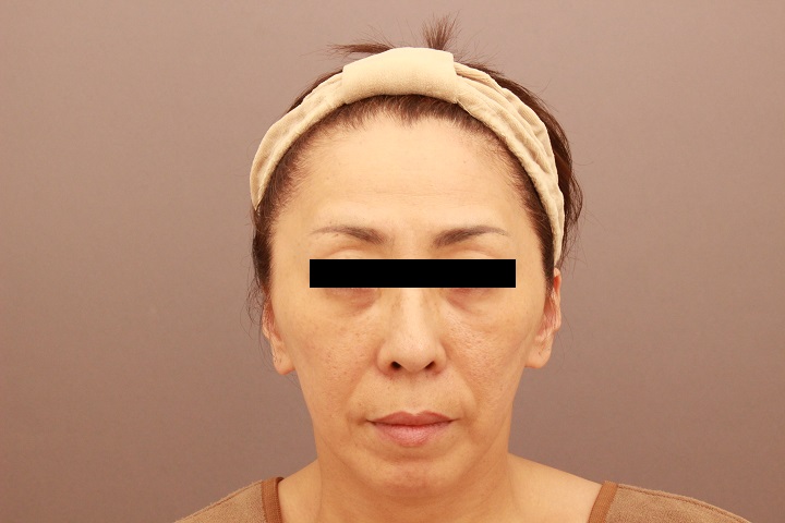 顔のエイジングケア