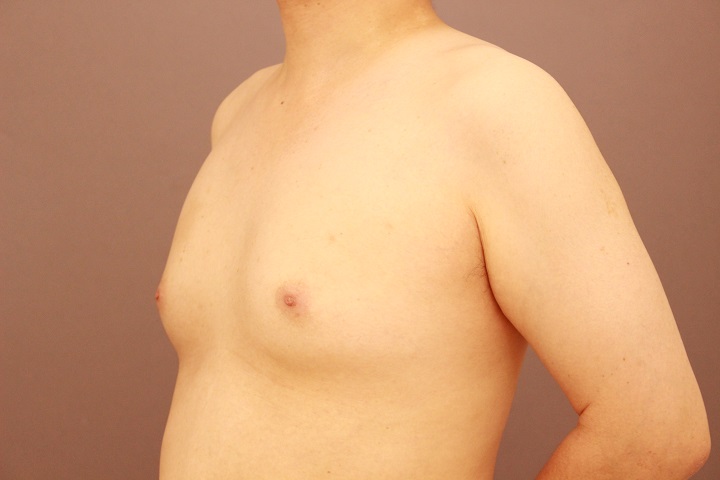 女性化乳房　１週間後経過