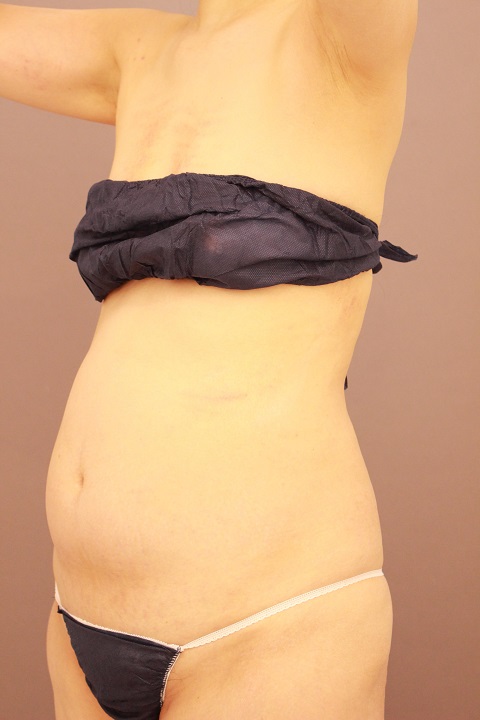 全腹部・腰　脂肪吸引　１週間後