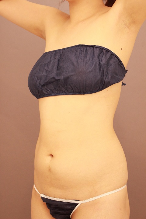 お腹・腰　脂肪吸引　１週間後経過