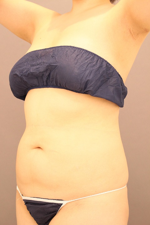 お腹・腰　脂肪吸引　３か月経過