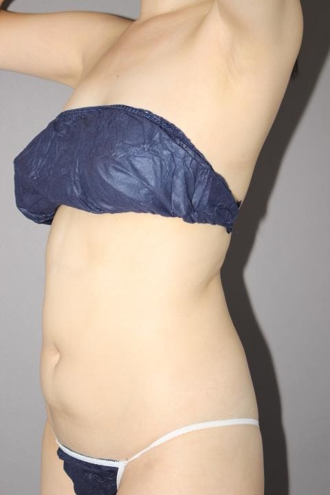 腹部全体・腰　脂肪吸引　半年経過