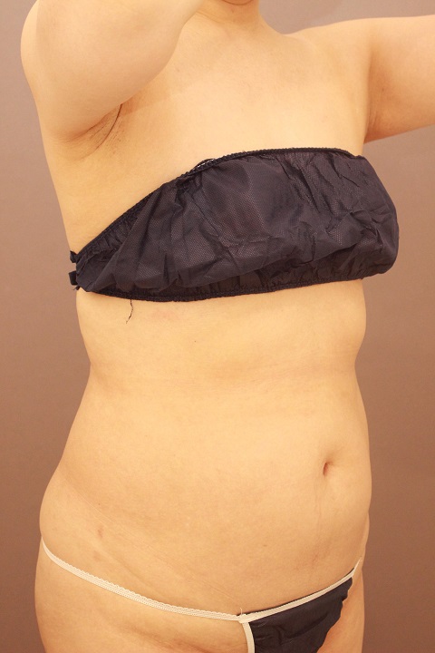 全腹部・胸下・腰　脂肪吸引１週間経過