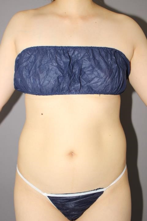 腹部・腰　脂肪吸引　半年経過