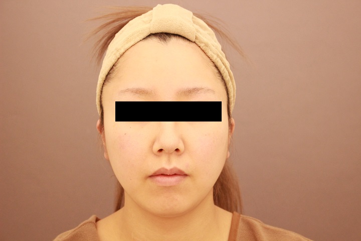 顔の脂肪吸引　半年後経過