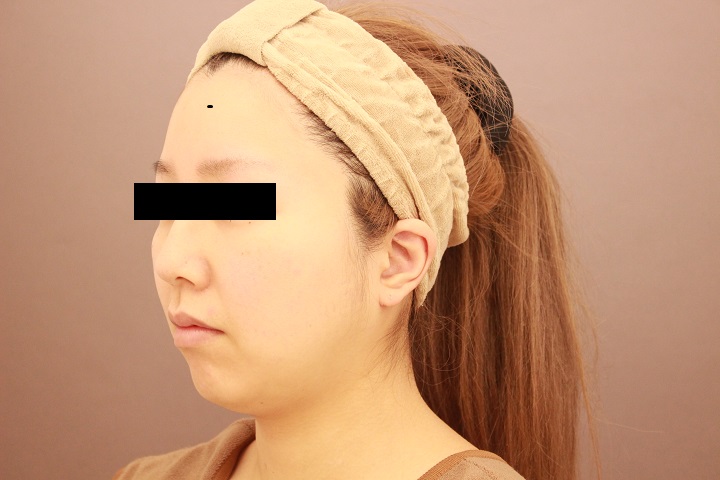 顔の脂肪吸引　１週間経過