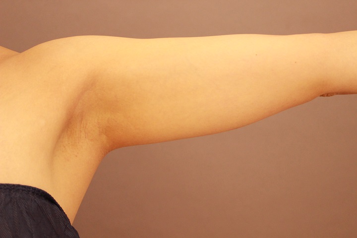 二の腕　脂肪吸引　翌日～１週間　術後経過