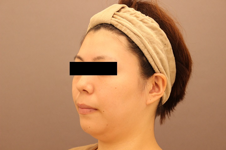 顔の脂肪吸引　半年経過