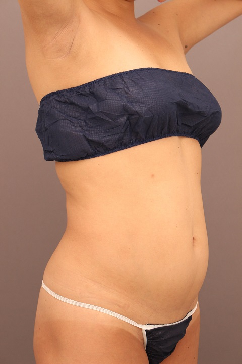 腹部全体・腰　半年後経過