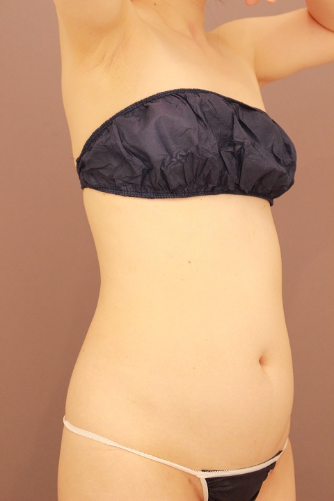 腹部全体・胸下・腰　脂肪吸引　半年経過