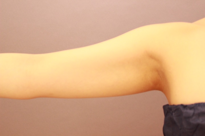 二の腕・肩 1か月経過