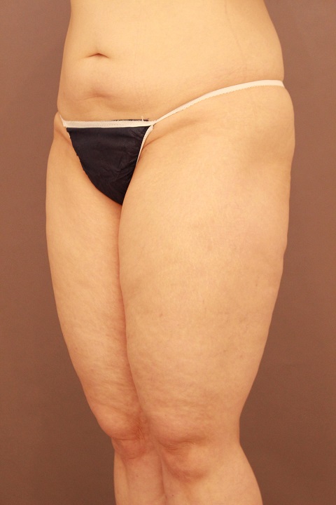 太もも全周・膝・臀部　1か月経過