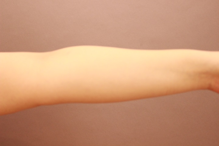 こんな部位も脂肪吸引可能です。