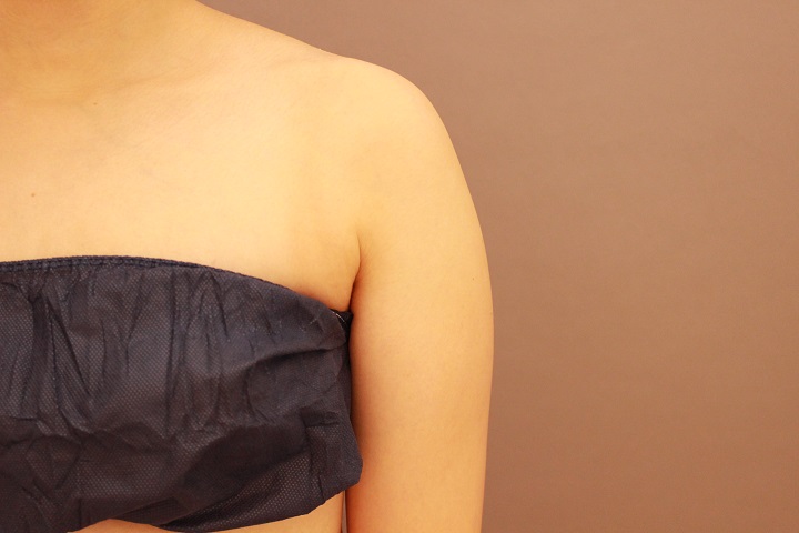 二の腕・肩　１か月経過