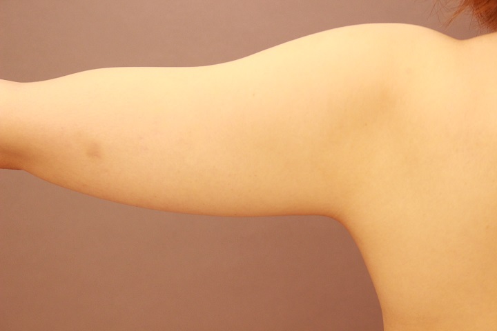 二の腕・肩 脂肪吸引 1か月経過