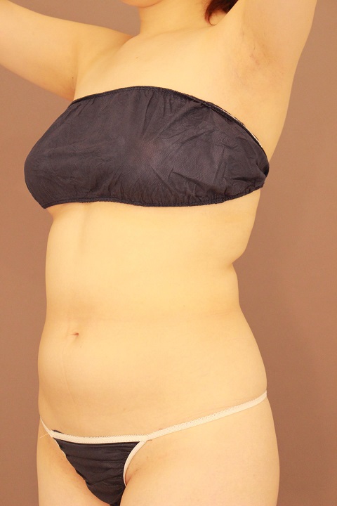 全腹部・胸下・腰　脂肪吸引　１か月経過