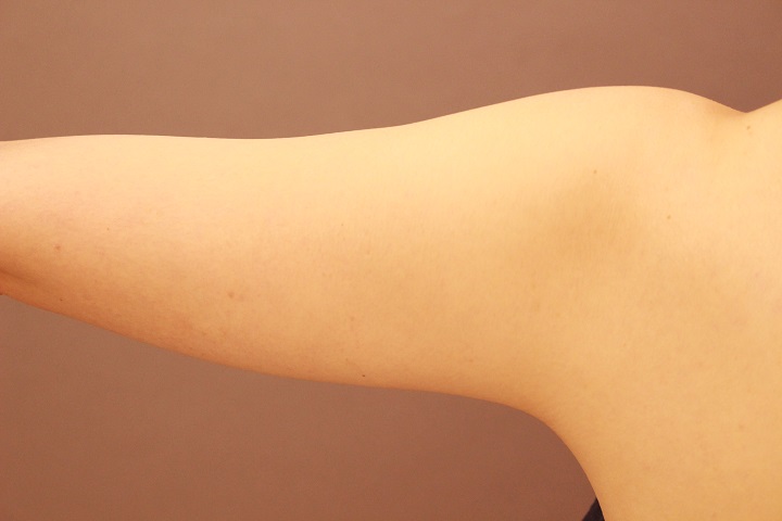 二の腕・肩　脂肪吸引　１か月経過