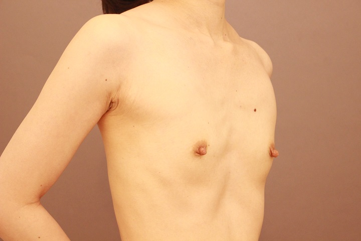 コンデンスリッチ豊胸　１か月経過