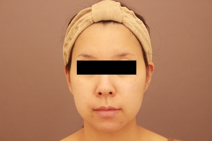 顔の脂肪吸引 翌日