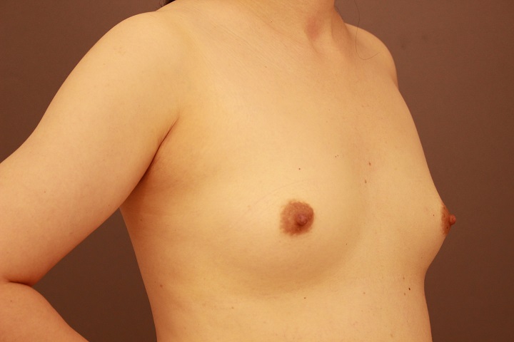 コンデンスリッチ豊胸 3か月経過