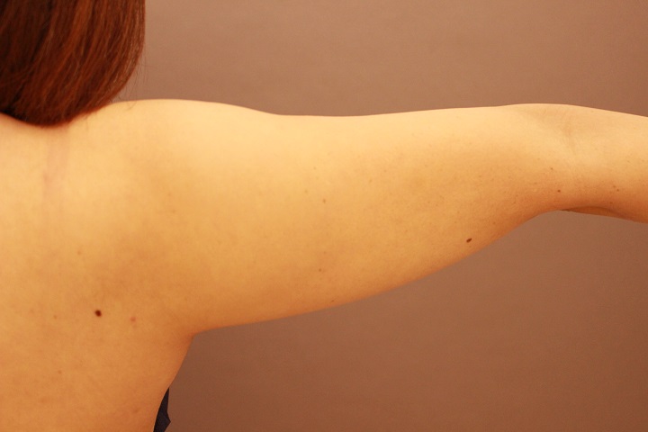 二の腕・肩 1か月経過