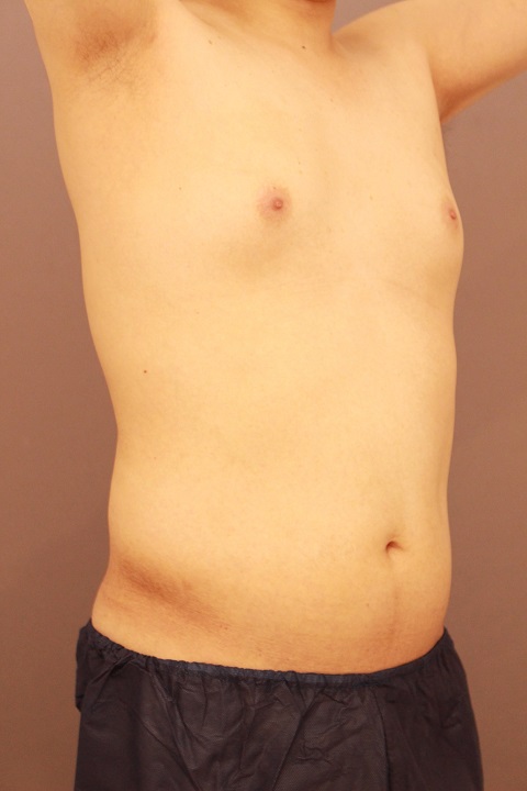 男性の脂肪吸引　１か月経過