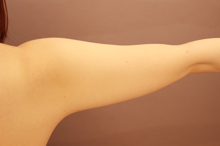 二の腕・肩　１か月経過