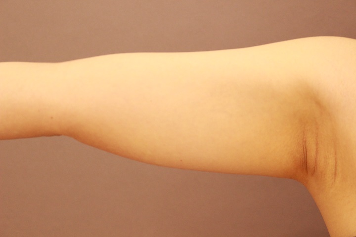 二の腕・肩　脂肪吸引　１か月経過