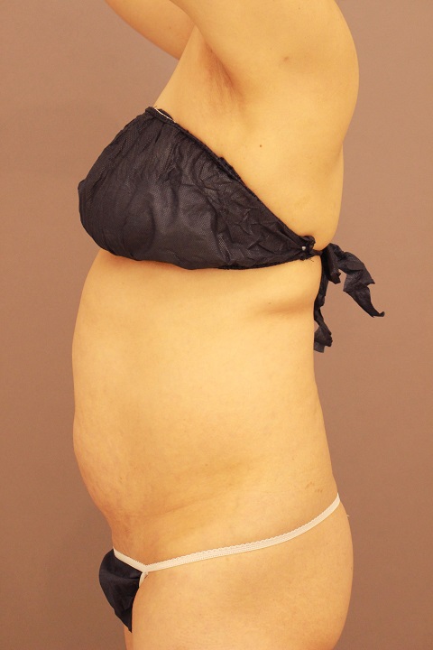 お尻のヒップメイキング　腹部・腰脂肪吸引　１か月経過