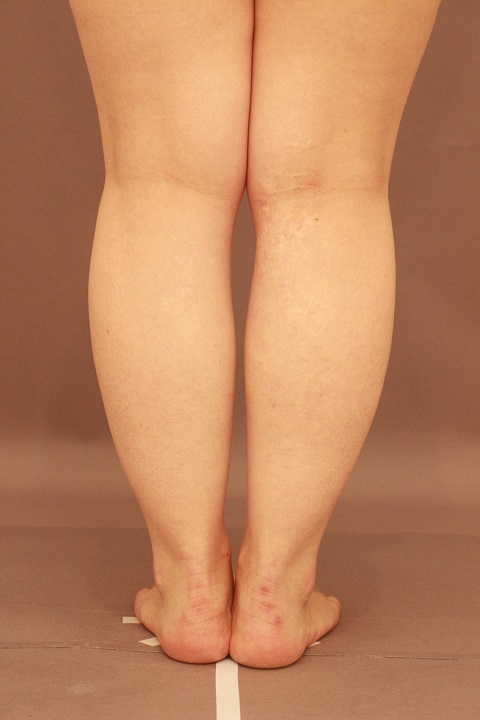 ふくらはぎの脂肪吸引　１か月経過