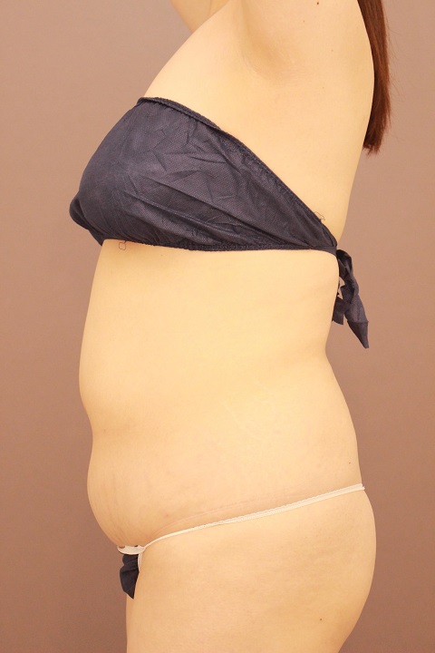 腹部全体・胸下・腰　脂肪吸引　３か月経過