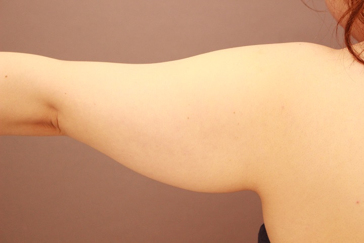 二の腕・肩　３か月経過