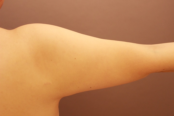 二の腕・肩　３か月経過