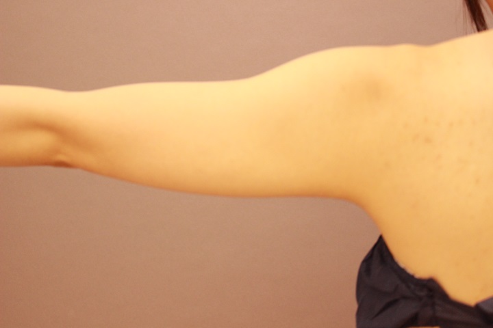 元々細い方の二の腕・肩　脂肪吸引　３か月経過