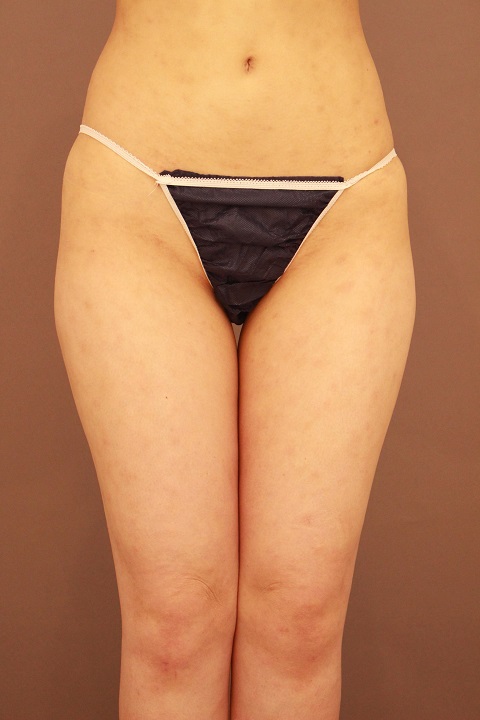 太もも　脂肪吸引　１か月経過