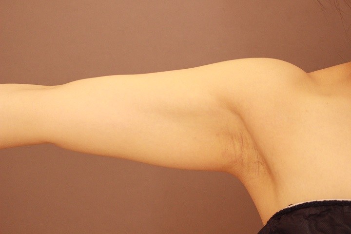 二の腕・肩　脂肪吸引　１か月経過